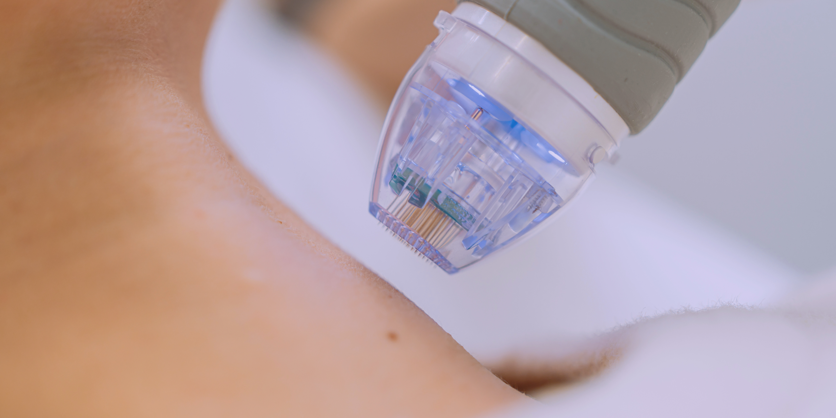 The Secret to Smoother, Younger-Looking Skin: How Microneedling Can Erase Neck Lines