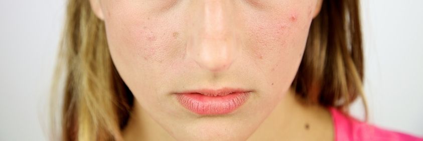 Why Regular Facials & the Right Products Help Handle Acne