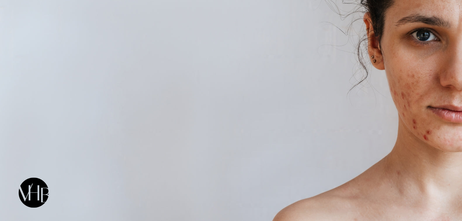 Acne-Prone Skin Reset: Your No-BS Guide to Starting Over