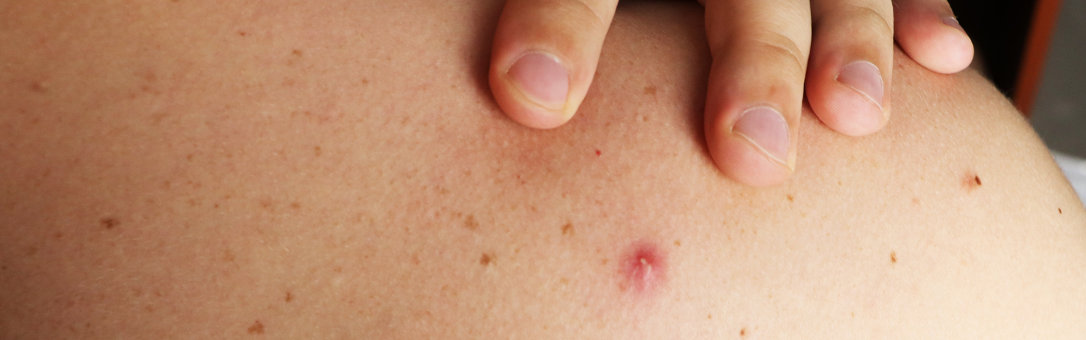 Conquering Chest and Back Acne: Your Ultimate Summer Skincare Guide