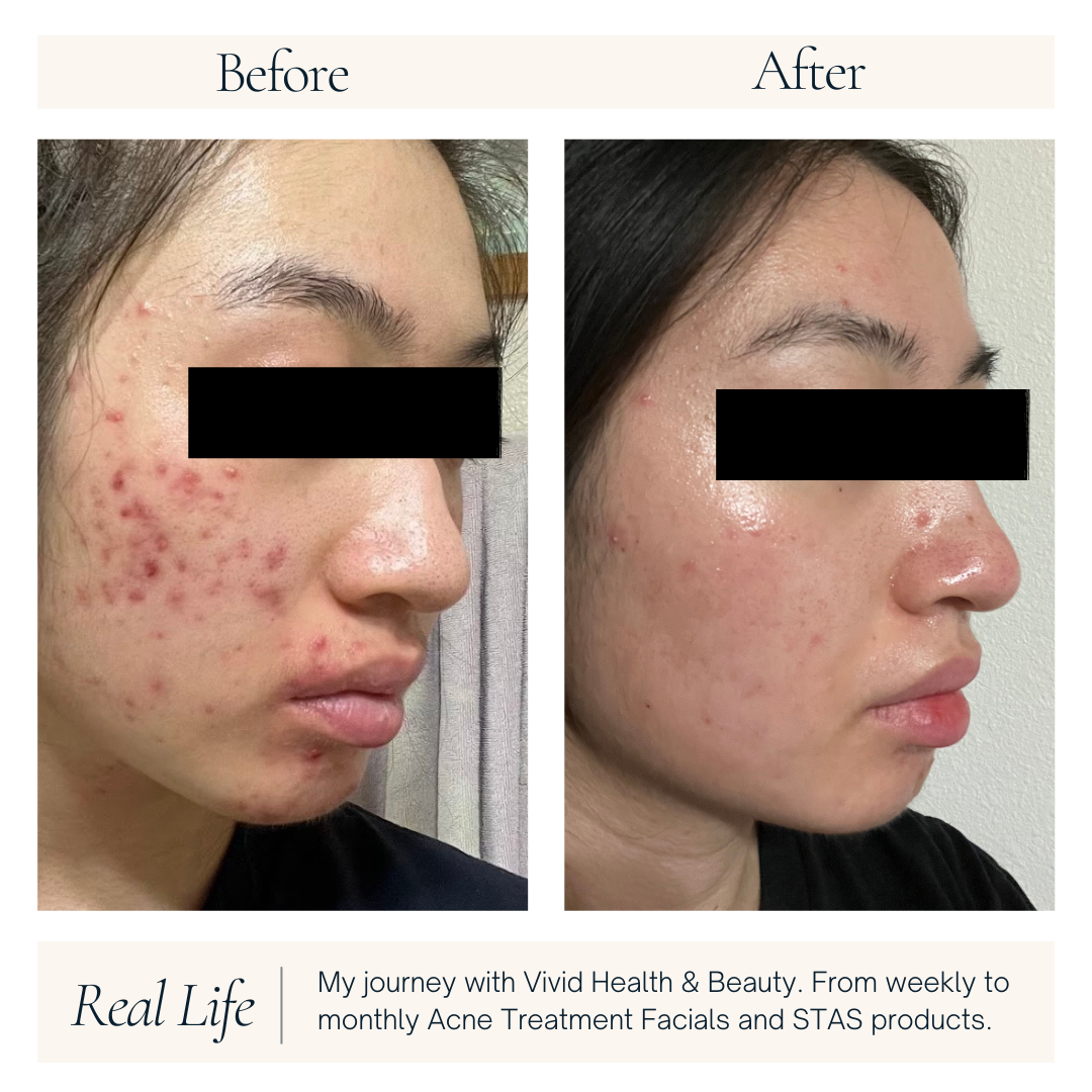My Skincare Transformation: Vivid Health & Beauty's Acne Treatment Facial
