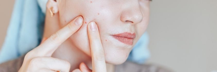 Acne Treatment and Prevention Tips for Teens