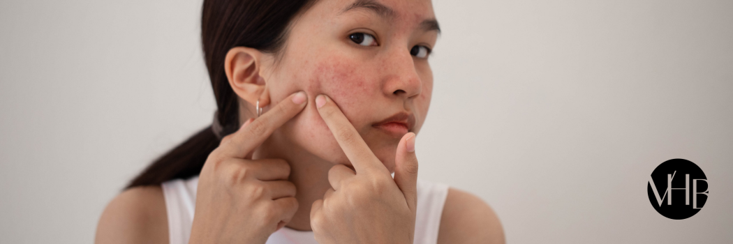natural acne remedies