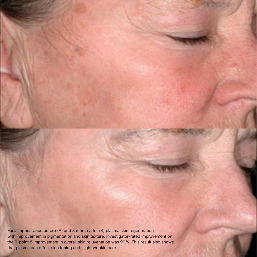 Can You Get Anti-Aging Results Without Botox or Fillers?