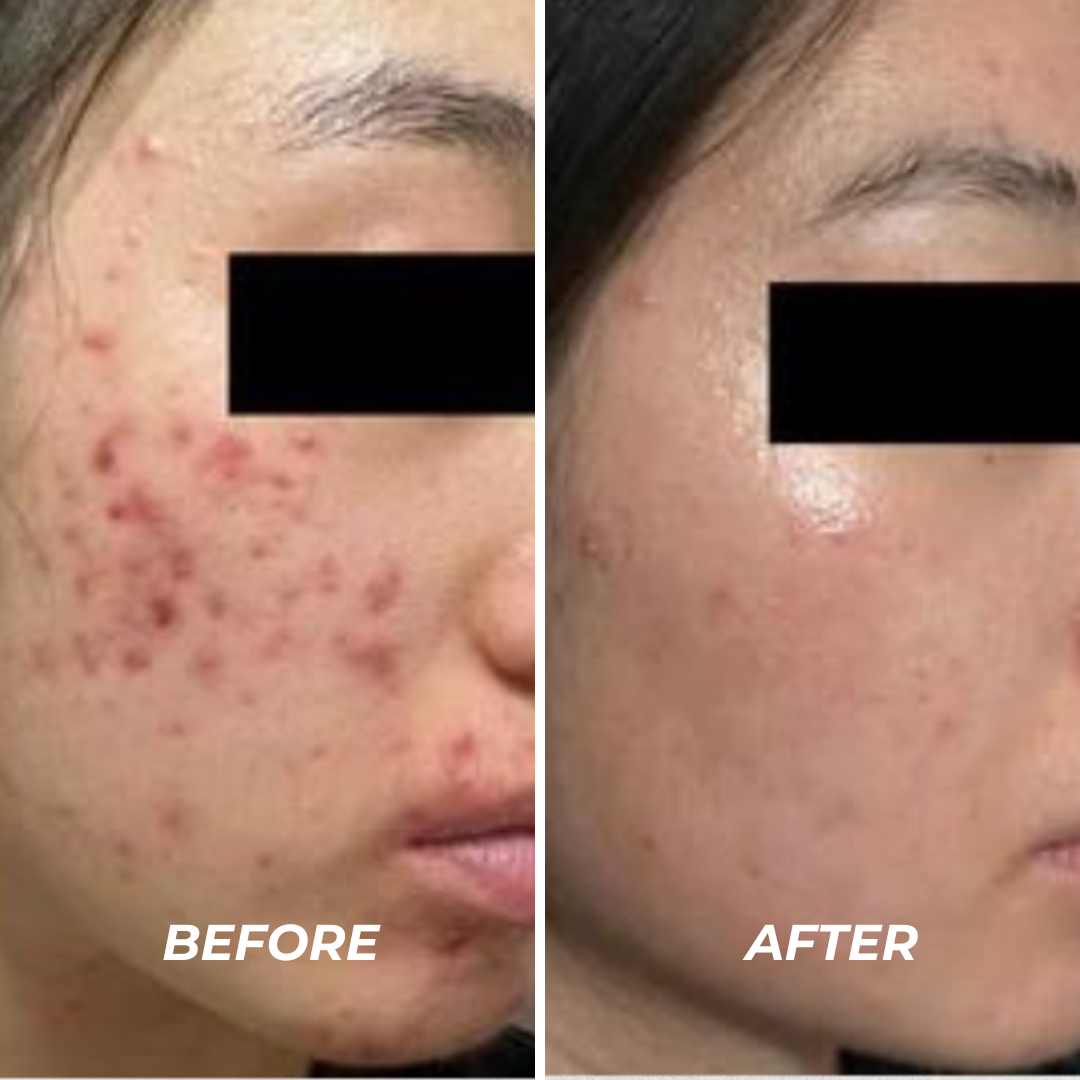 Acne Treatment Facial