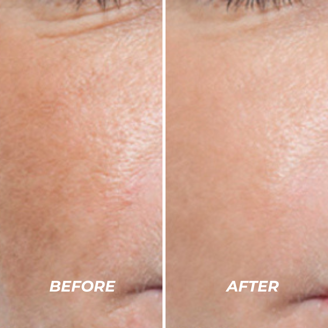 Plasma Sono Treatment - VHB Skincare