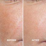 Plasma Sono Treatment - VHB Skincare