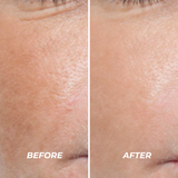 Plasma Sono Treatment - VHB Skincare