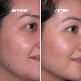 Microdermabrasion and Mini Cool with Yeast Extract - VHB Skincare