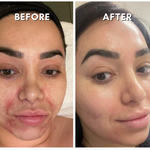 Intensif RF Microneedling Treatment Neck Treatment - VHB Skincare