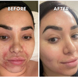 Intensif RF Microneedling Treatment Neck Treatment - VHB Skincare