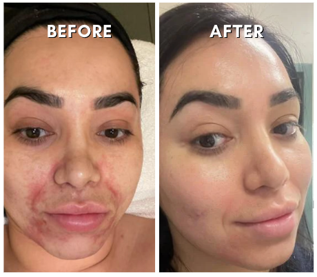 Intensif RF Microneedling Treatment Neck Treatment - VHB Skincare