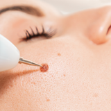 Mole, Freckle, Spot Removal - VHB Skincare