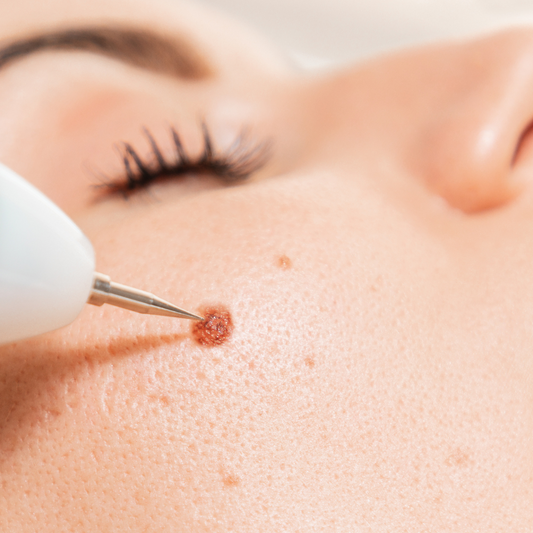 Mole, Freckle, Spot Removal